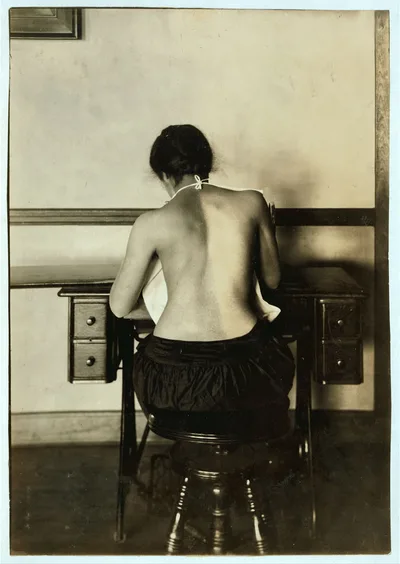 Mildred Benjamin, 17 years old. Right dorsal curvature. Scoliosis.…, Massachusetts, 1917