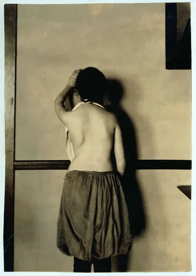 Same girl as no. 4665. Showing the slight deformity of the hip. Work…, Massachusetts, 1917
