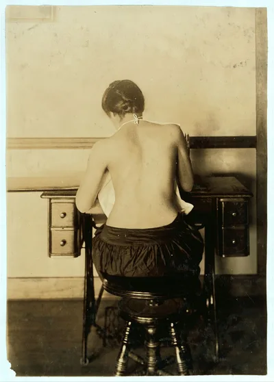 [Mildred Benjamin, 17 years old. Right dorsal curvature. Scoliosis.…, Massachusetts, 1917